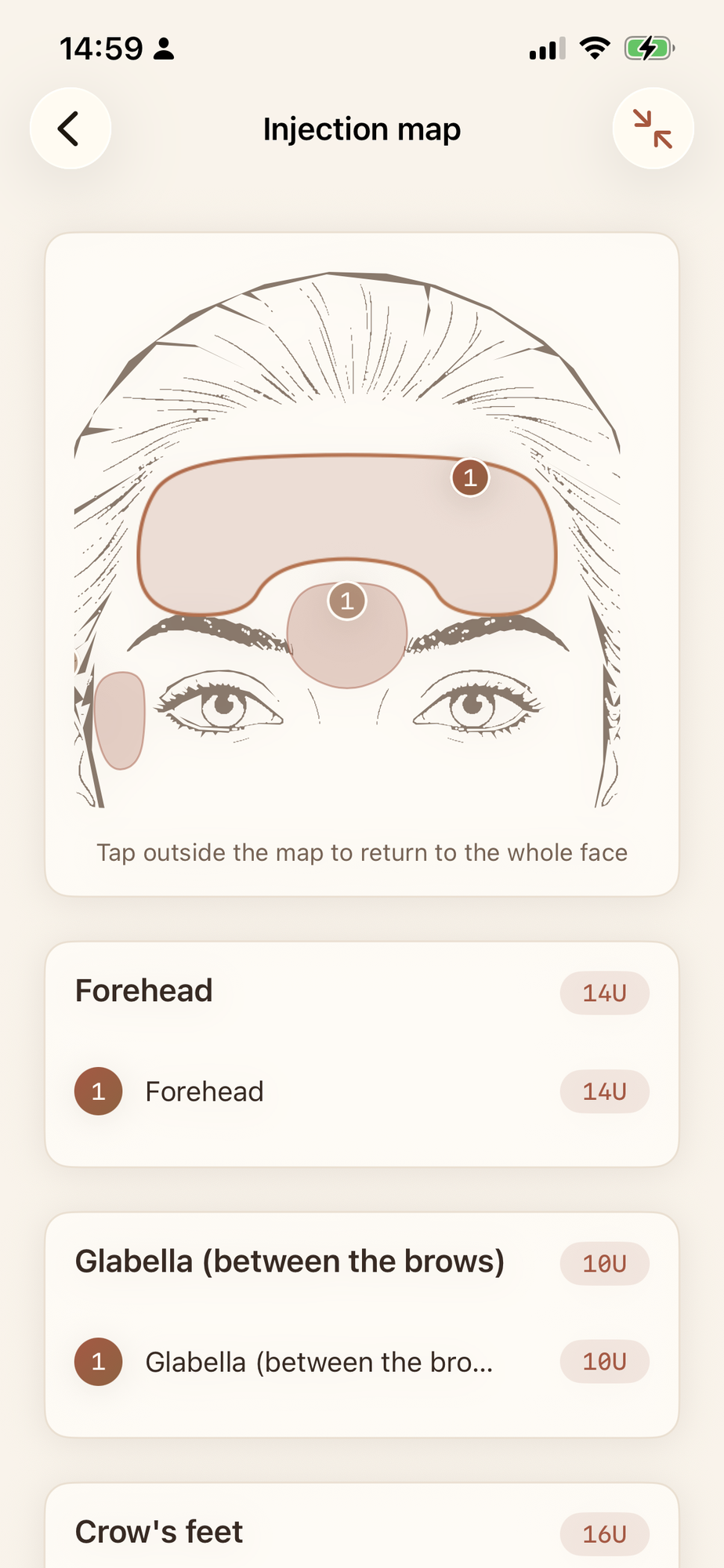 Ruyana injection map zoomed into the forehead with units per region